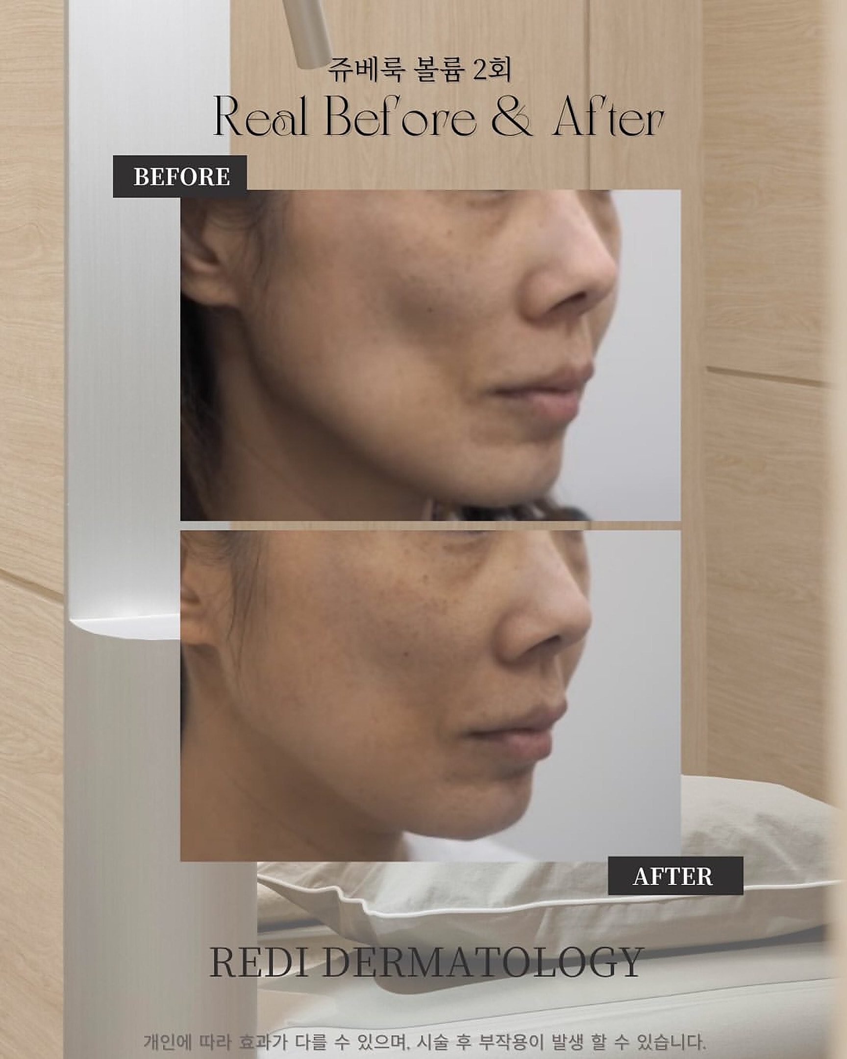 Juvelook Volume 2 次前後 — 側臉容積與線條改善(REDI)